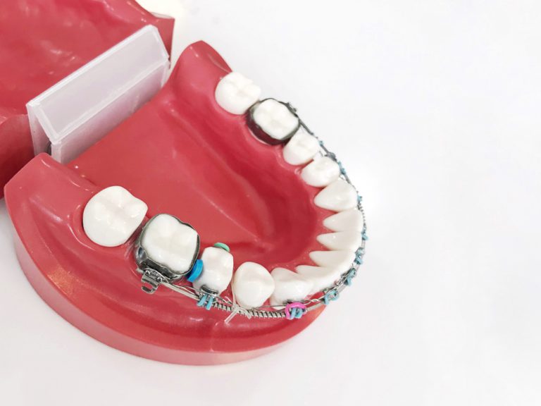 Can You Put Braces On Teeth With Crowns 