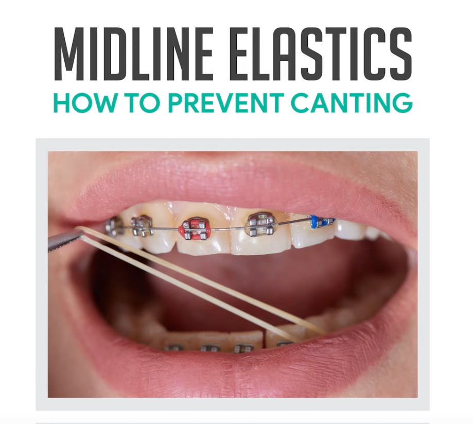 Midline Elastics Preventing Canting