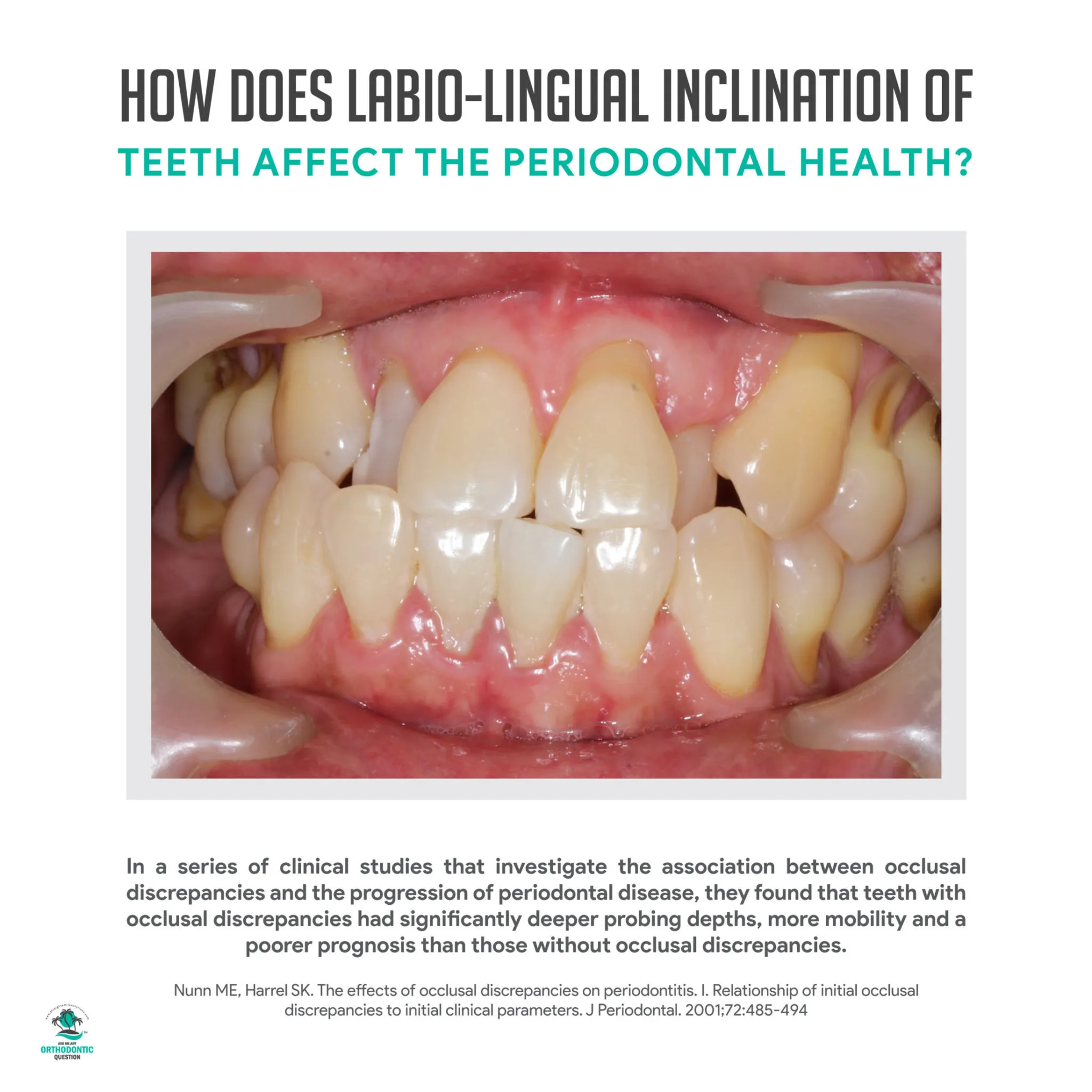 labio-lingual-inclination-and-periodontal-health