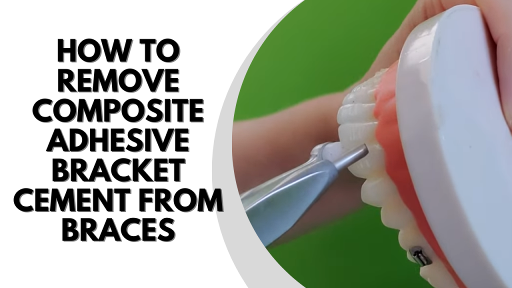 How to Remove Composite Adhesive Bracket Cement