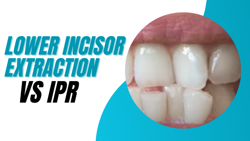 Ipr Color Increment Lower Incisor Extraction vs IPR