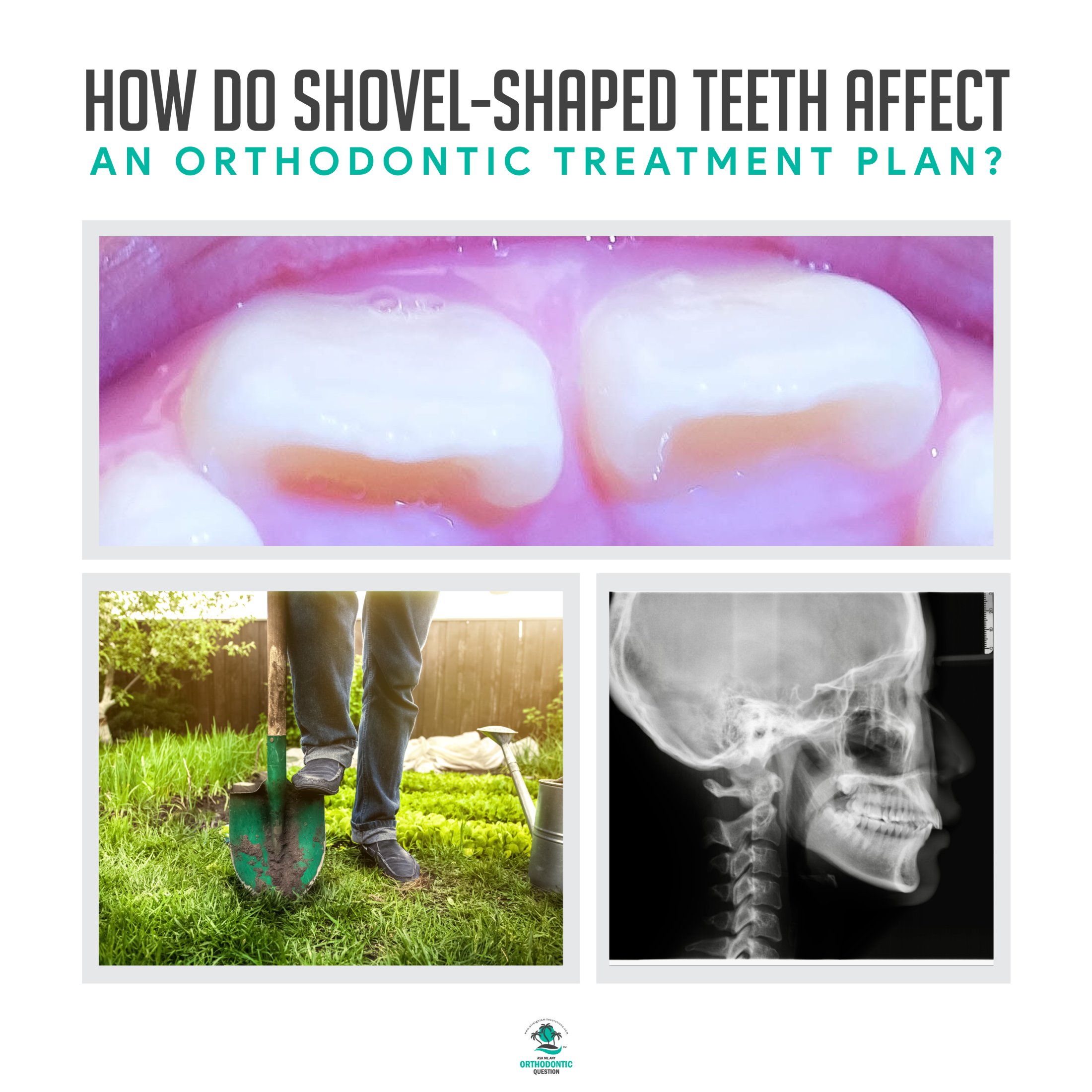 What You Should Know About Treatment Plans for ShovelShaped Teeth