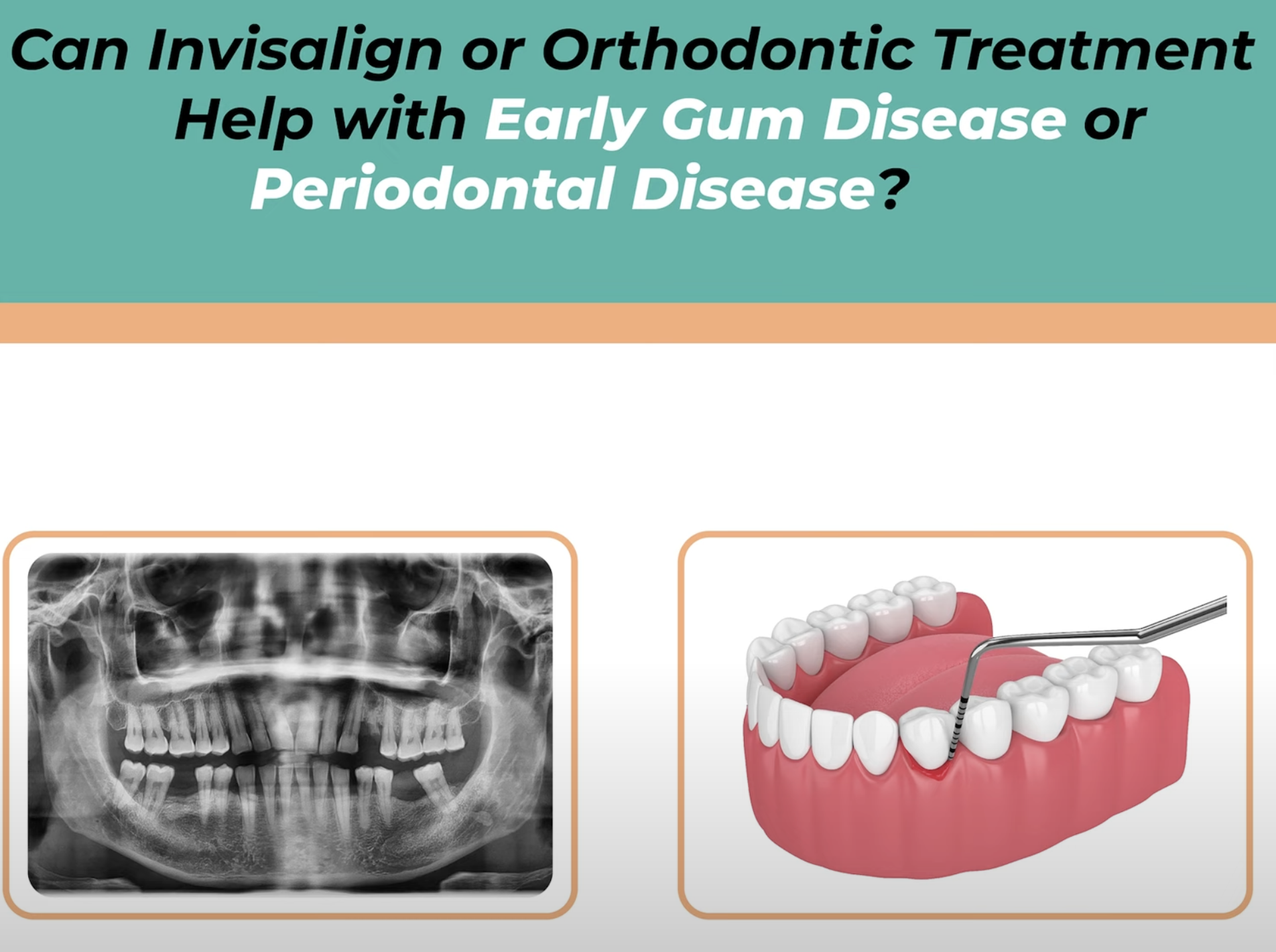 The Link Between Early Gum Disease and Orthodontics and How Invisalign Can Help