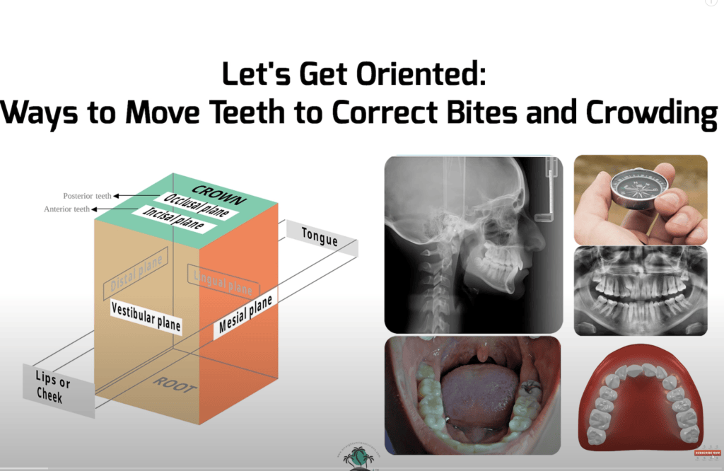 Ipr Color Increment Ways to Move Teeth and Correct Crowding: IPR, SD, Expansion ...