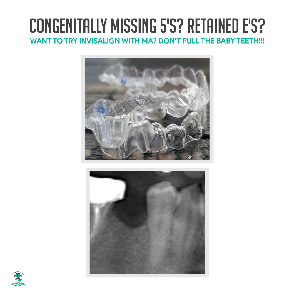 Why You Should Never Pull Baby Teeth with Invisalign MA