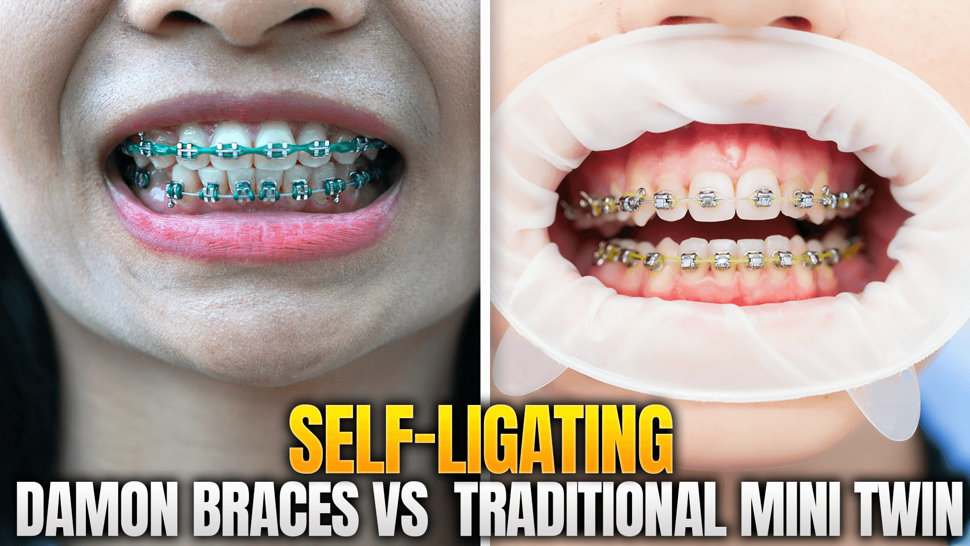 Self Ligating / Damon Braces vs Traditional Mini Twin