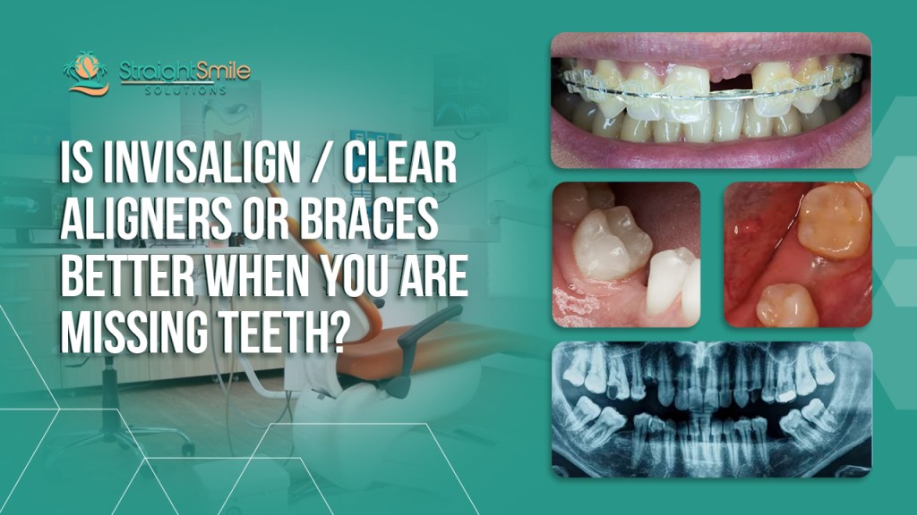 Missing Tooth Cases; Invisalign and Clear Aligners or Braces?