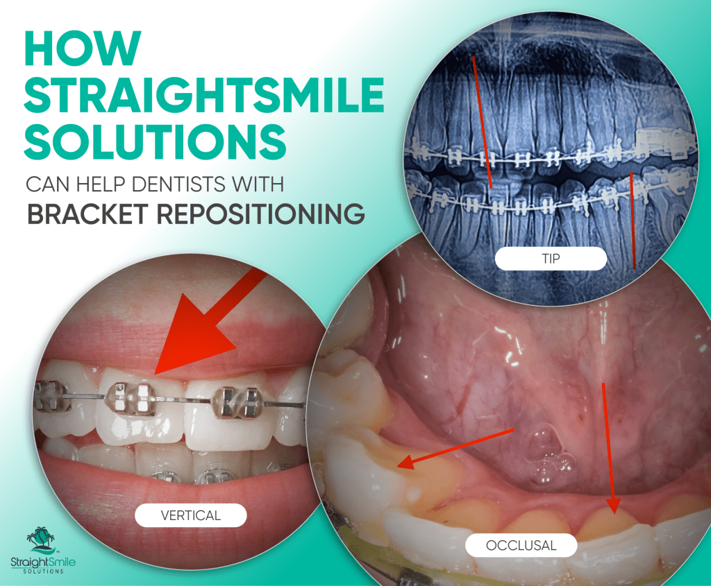 Bracket Repositioning How Straight Smile Solutions Can Help