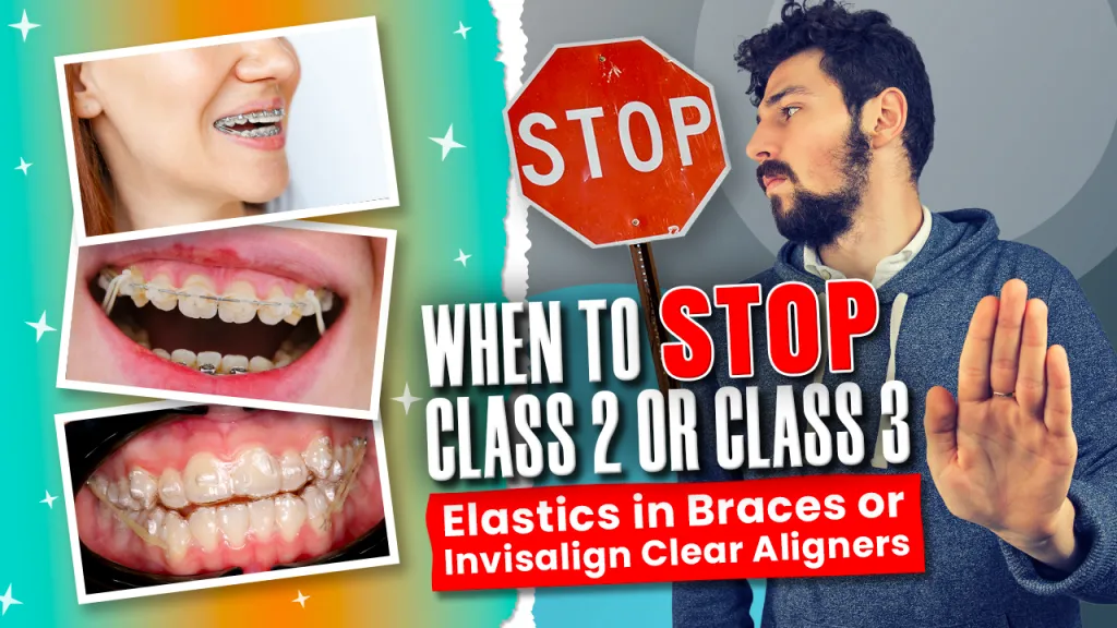 Cii Elastics Invisalign When to STOP Invisalign or Braces Class 2 or Class 3 Elastics