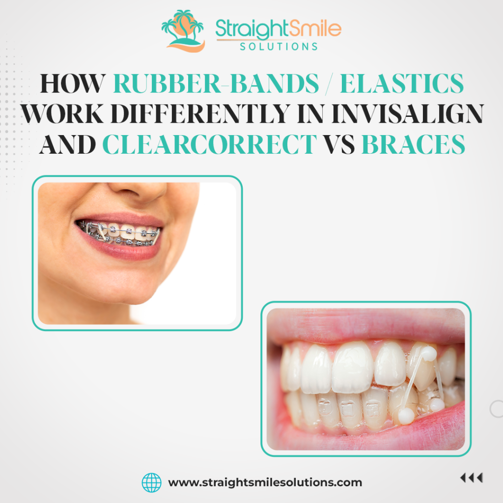 How Elastics Work Differently in Invisalign and ClearCorrect vs Braces