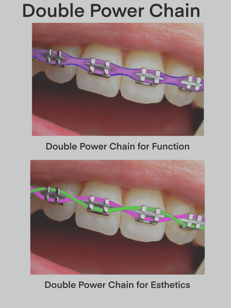 Power Chain Invisalign What are the Risks of Double Power Chain?