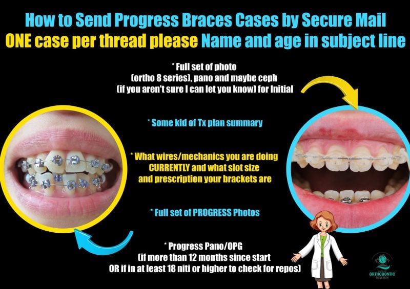 Braces ang Retainers - How to's