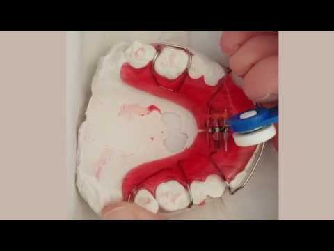 How to Turn Your Schwartz or RPE Palatal Expander Video Thumbnail